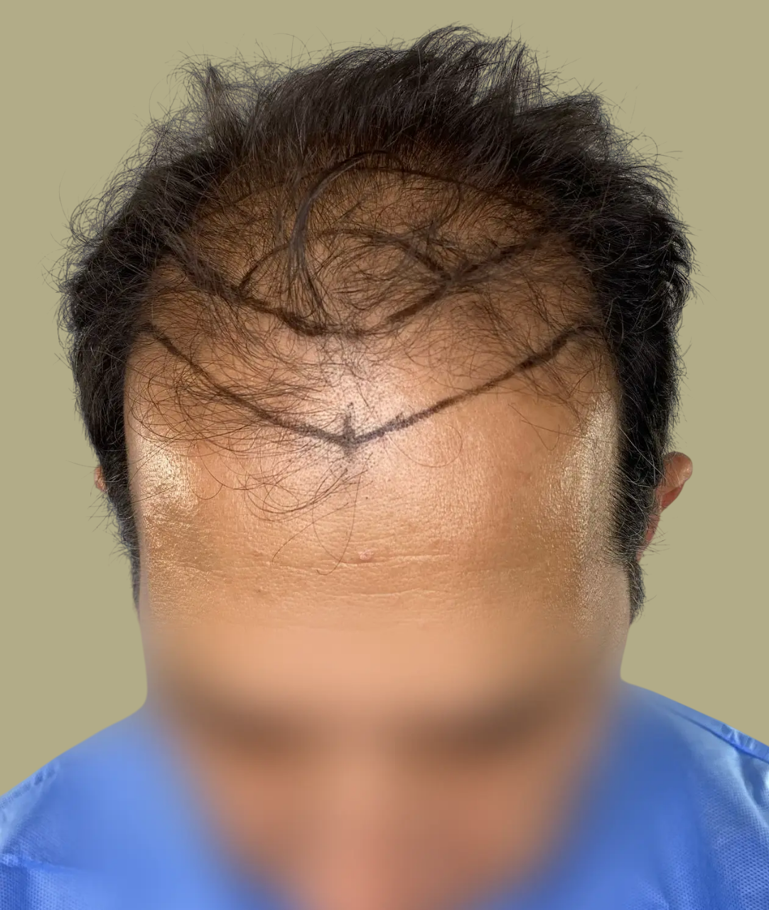 Antes Depois 47-Photoroom