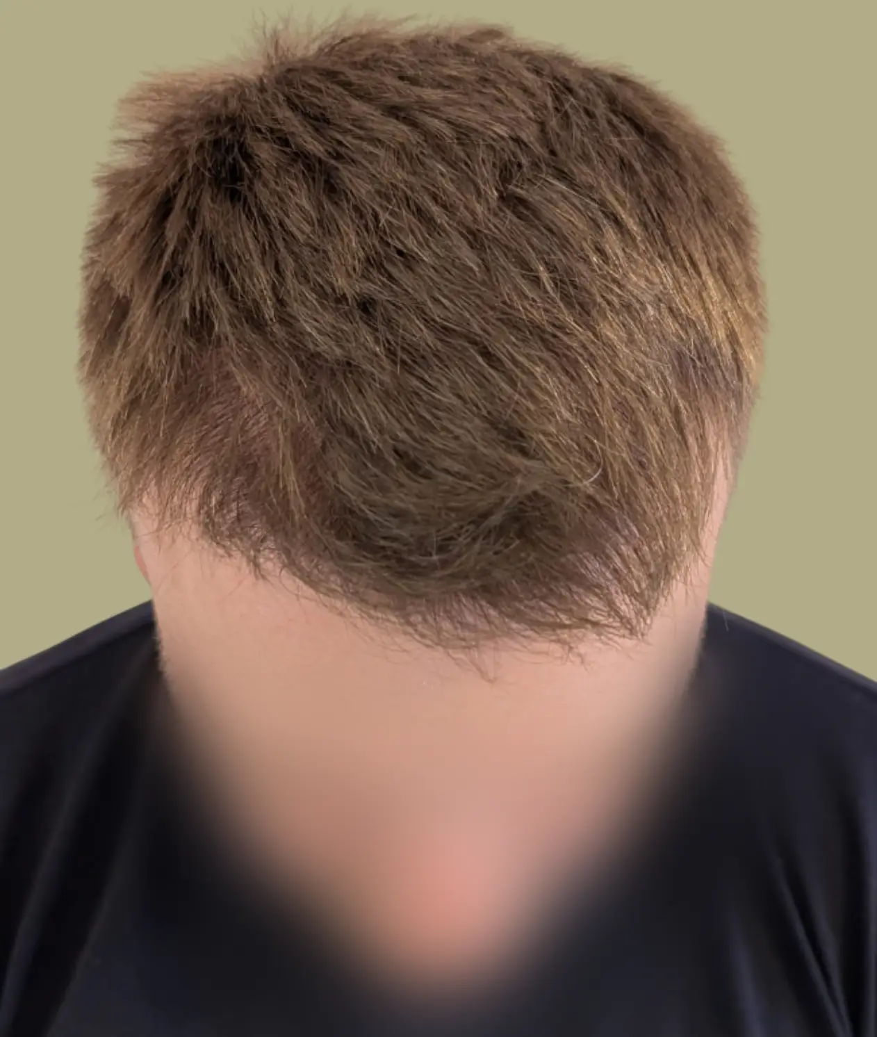Depois Foto