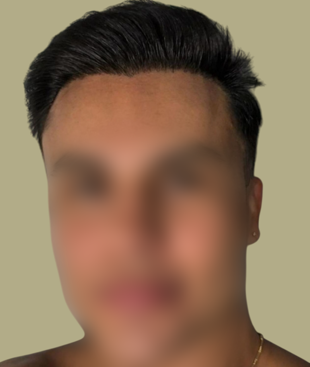 transplantes-depois-1-Photoroom